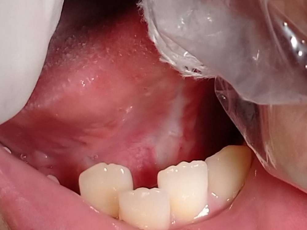 術後　舌小帯切除術
