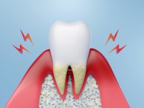 歯周病の原因は？歯周病にならないためのポイントも解説