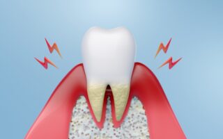 歯周病の原因は？歯周病にならないためのポイントも解説