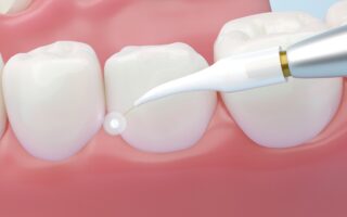 歯周病の治療法・治し方の種類と流れは？自分でも治せるのかも解説