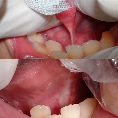 症例写真　レーザーによる舌小帯切除術