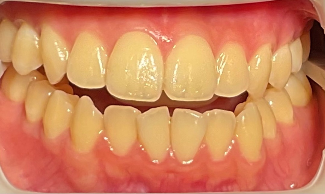 術前　ホワイトニング