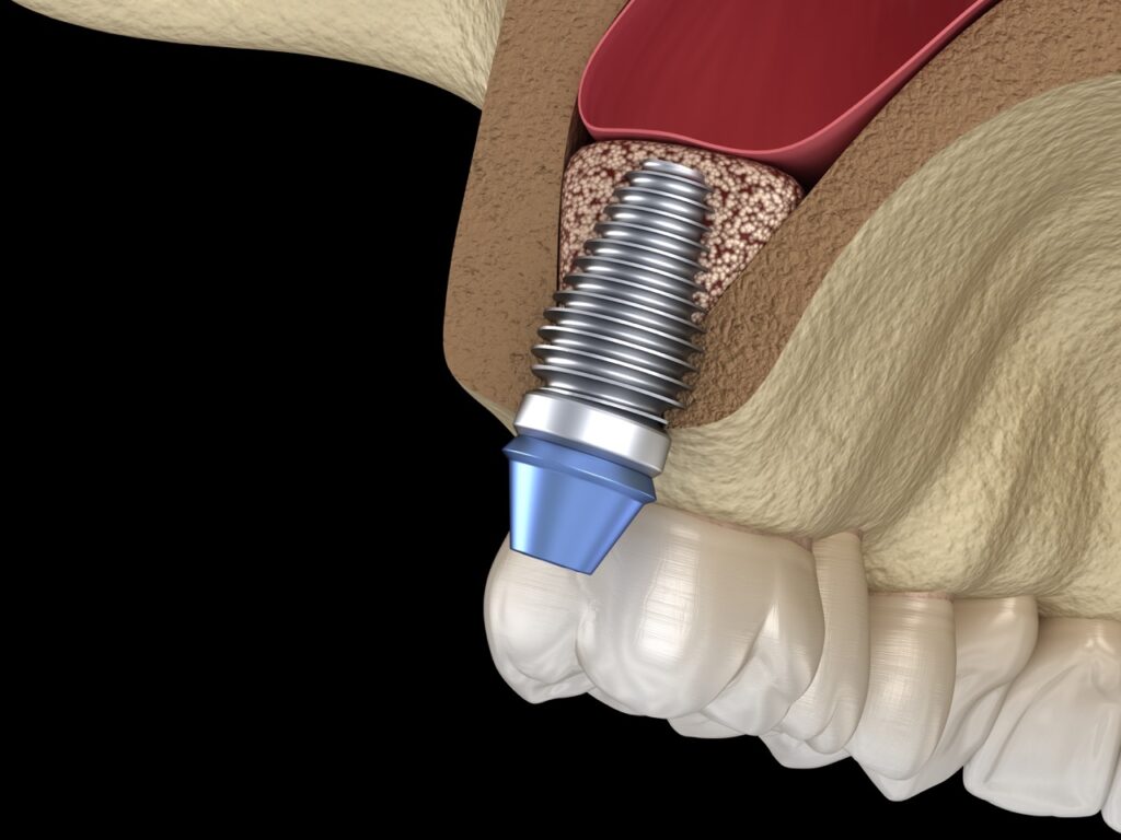 骨が足りなくてもインプラントができる骨造成とは？成功率や術後の腫れなどの経過も解説