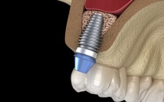 骨が足りなくてもインプラントができる骨造成とは？成功率や術後の腫れなどの経過も解説