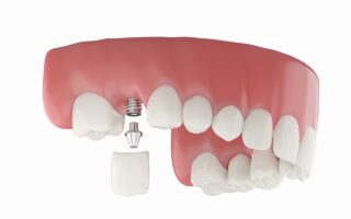 奥歯のインプラント治療のデメリットとメリットは？難しいとされる理由も解説