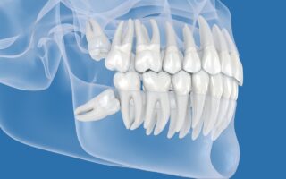 親知らずは生え方で抜歯の難易度が変わる？抜くタイミングについても解説