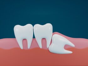 埋伏智歯・水平埋伏智歯 (親知らず)の抜歯手順と注意点は？放置した場合のリスクも解説