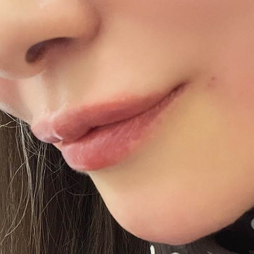 術後 ヒアルロン酸注射