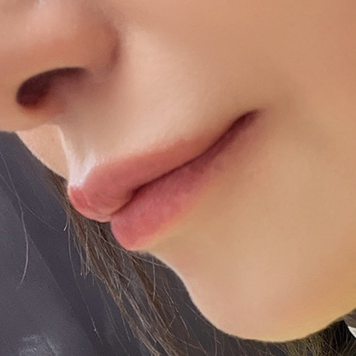 術前 ヒアルロン酸注射