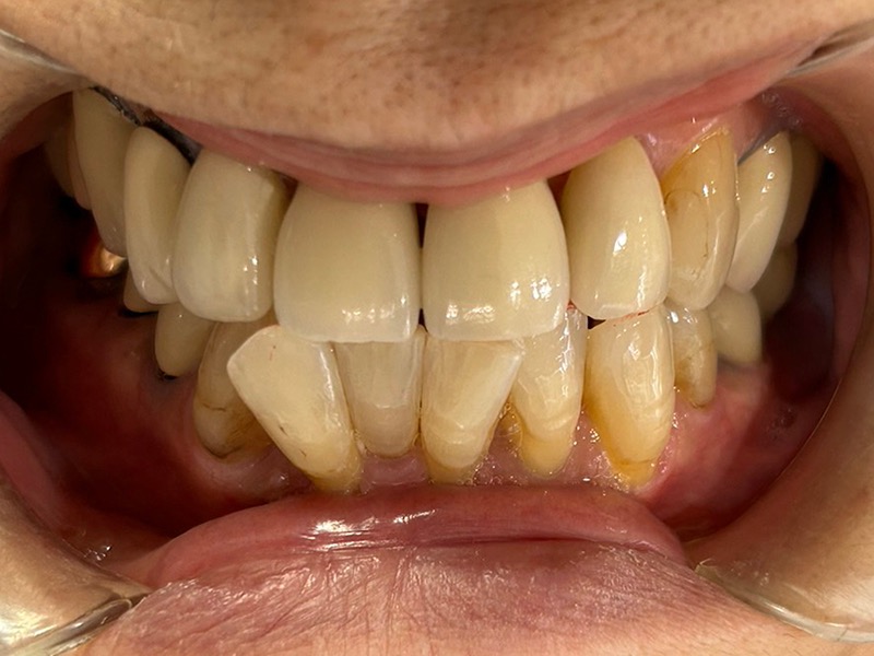 術後　インプラント