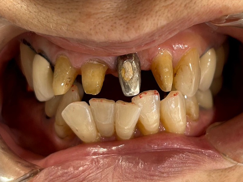 術前　インプラント