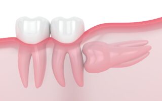 水平埋伏智歯の抜歯後に注意するポイントは？腫れ、痛みや日常生活について