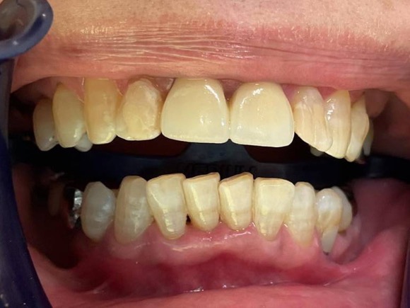 術後 ジルコニア