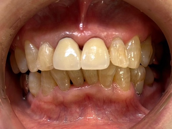 術後 ジルコニア