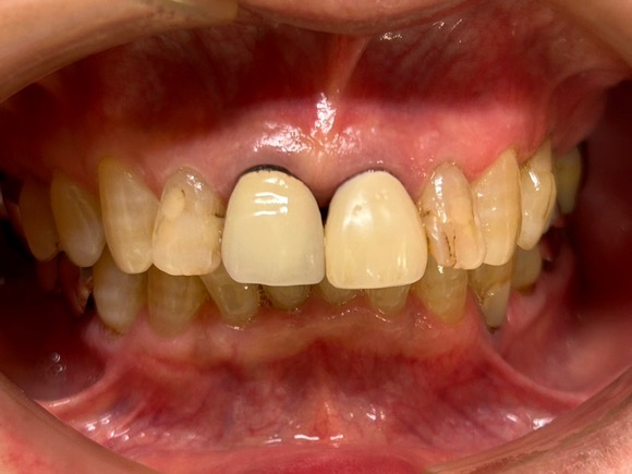 術前 ジルコニア