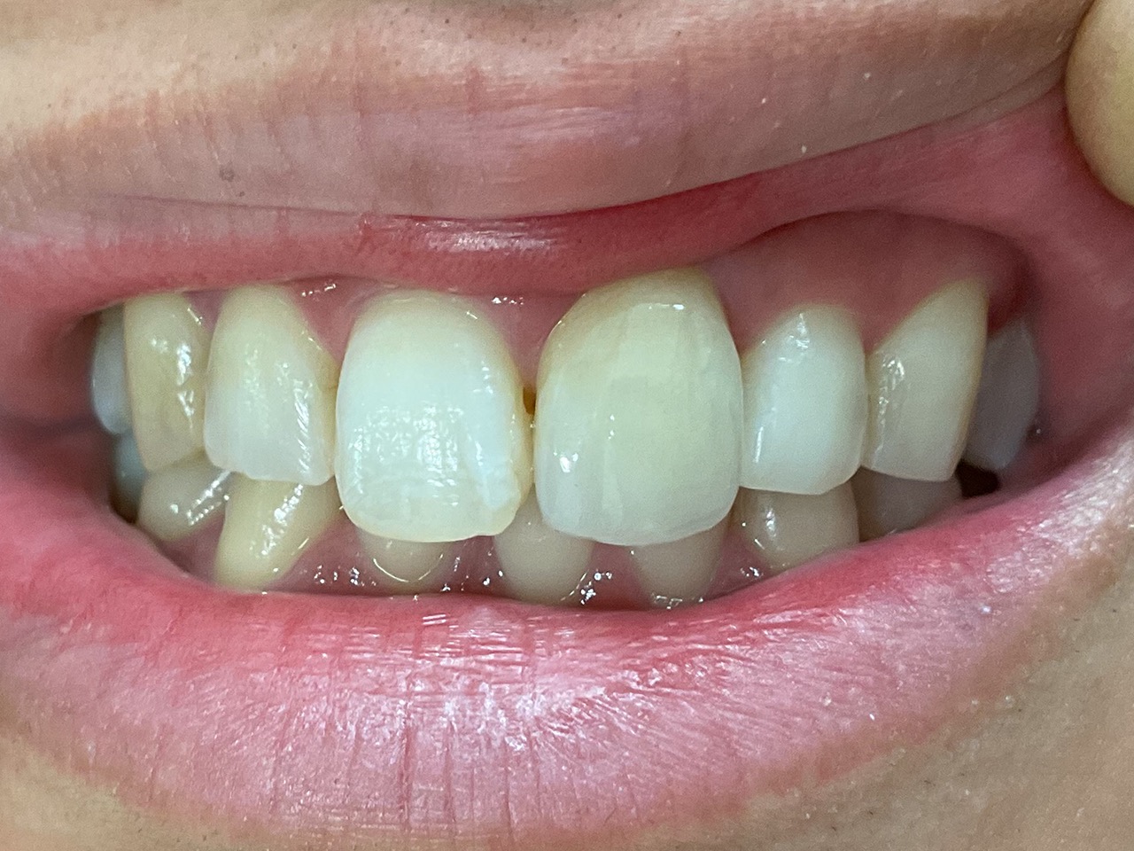 術後 ジルコニア