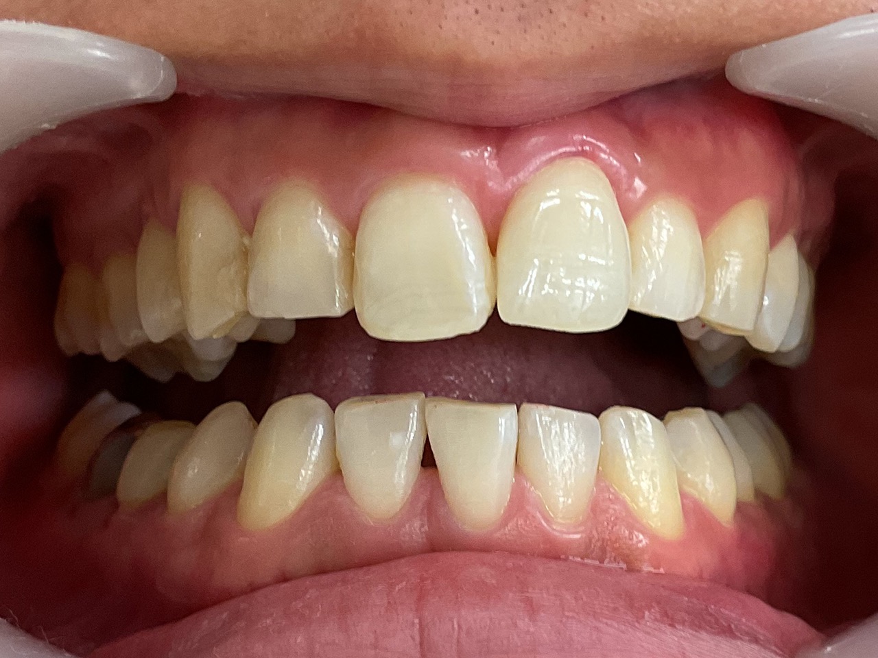 術前 ジルコニア