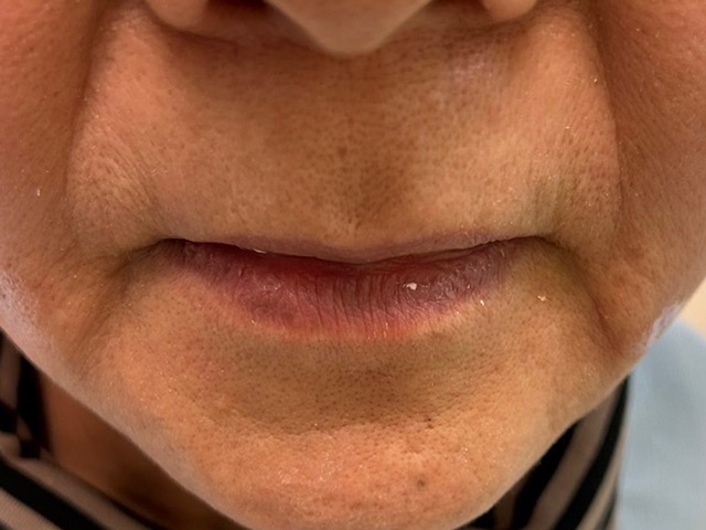 術前 ヒアルロン酸注射