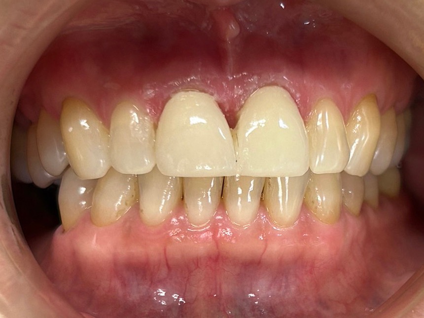 術後 ジルコニア