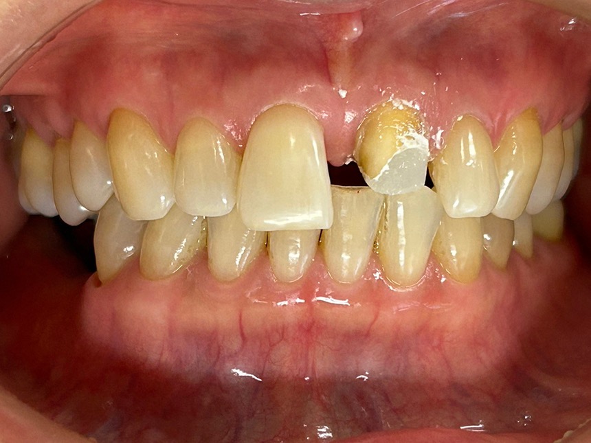 術前 ジルコニア