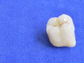 差し歯が取れたらどうする？取れる前兆や原因・対処法について