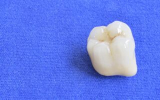 差し歯が取れたらどうする？取れる前兆や原因・対処法について